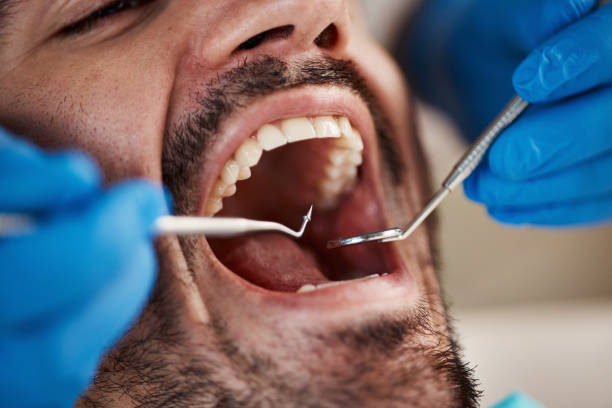Full Mouth Reconstruction in Konterra, MD